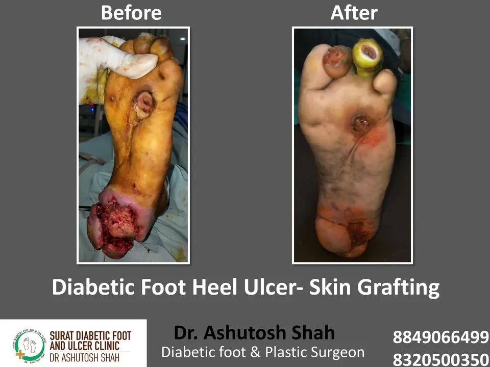 Diabetic Foot  PPT 3 checked by sir.pptx-94.webp